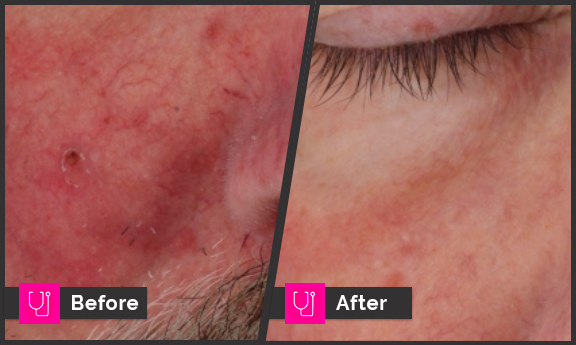 Prima 3 rxs Rosacea R Cheek