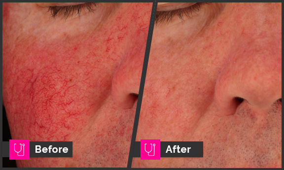 Rosacea - Perfecta rxs R