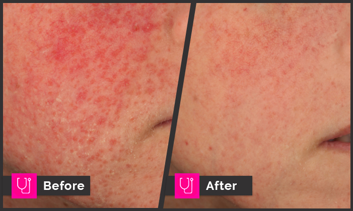 Rosacea KPRF Right Cheek