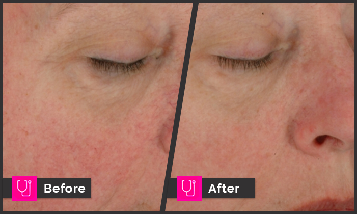 Rosacea Right Cheek