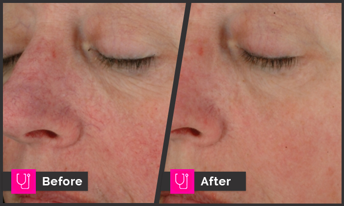 Rosacea Left Cheek