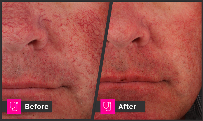 Rosacea Central Face