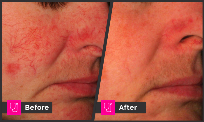 Rosacea