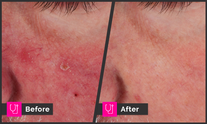 Rosacea Left Cheek