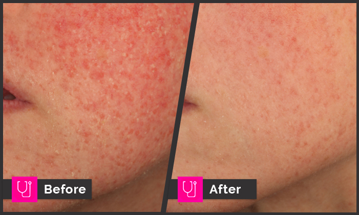 Rosacea KPRF Left Cheek