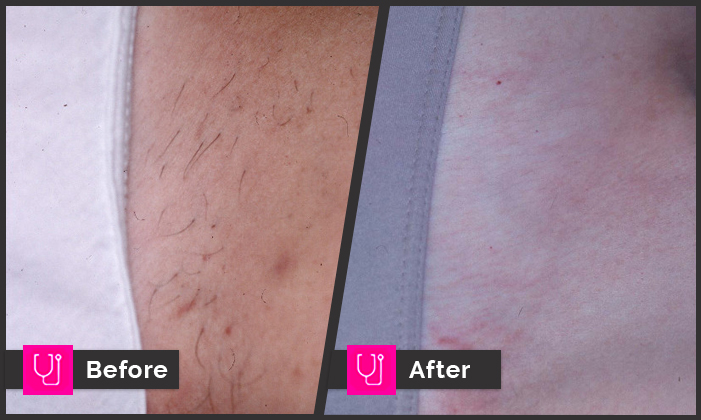 Bikini Hair Removal with Folliculitis