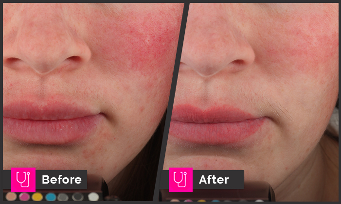 Rosacea