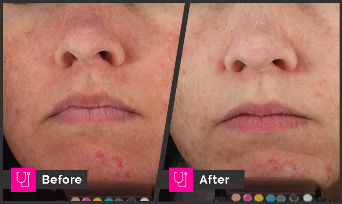 Rosacea DermaV 1 rx